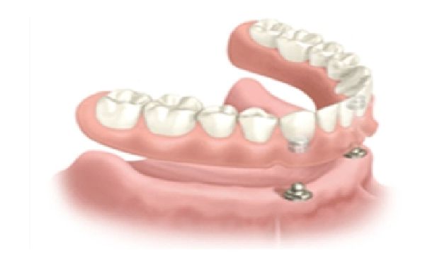 implant denture