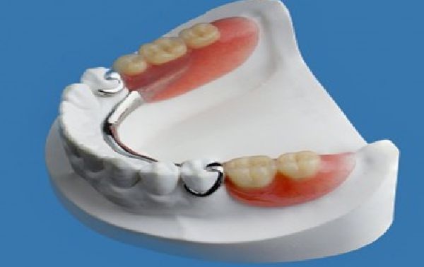 Partial Denture